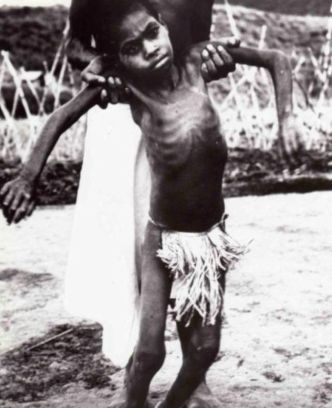 A young child impacted by kuru. Credit: Wikipedia Commons 