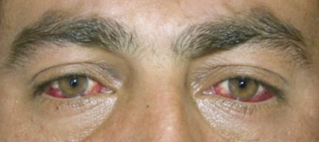 A patient infected with CCHF. Credit: American Journal of Ophthalmology