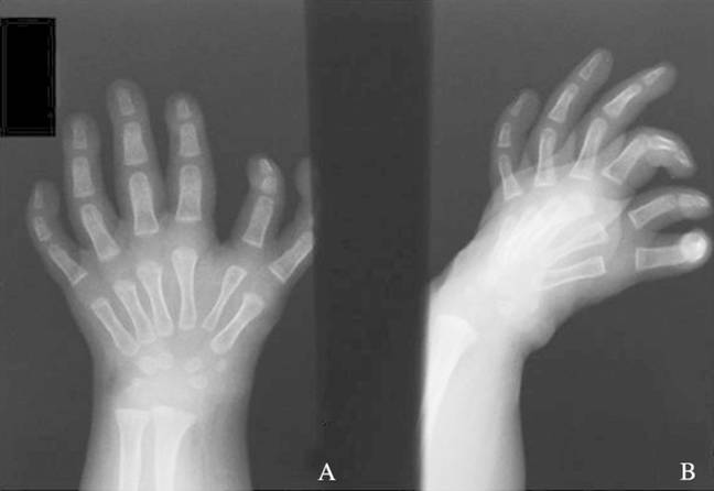 Dimelia Rare ‘mirror hand’ syndrome causes one hand to be completely symmetrical
