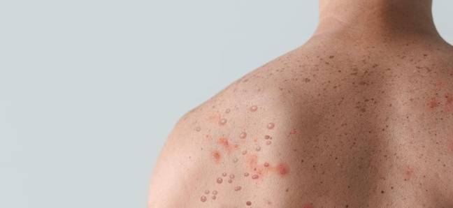 Monkeypox often causes a distinctive rash. Credit: Jozef Polc/Alamy Stock Photo