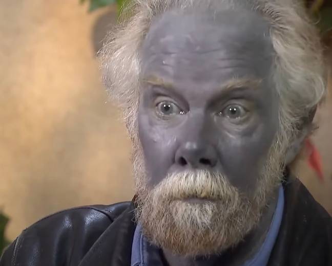 For over a decade, Paul would self-medicate his skin condition dermatitis by consuming a silver compound mix. Credit: Inside Edition/YouTube