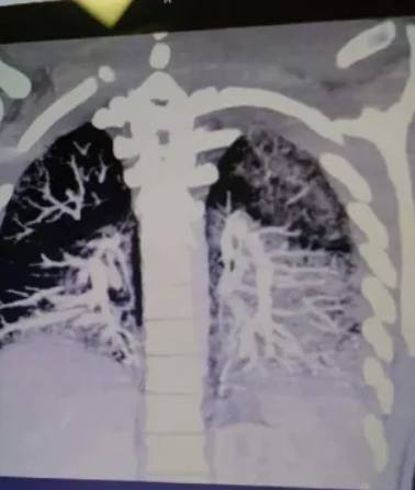 His dad Keith Mayo is now sharing the X-rays to encourage others to quit vaping. Credit: Keith Mayo  