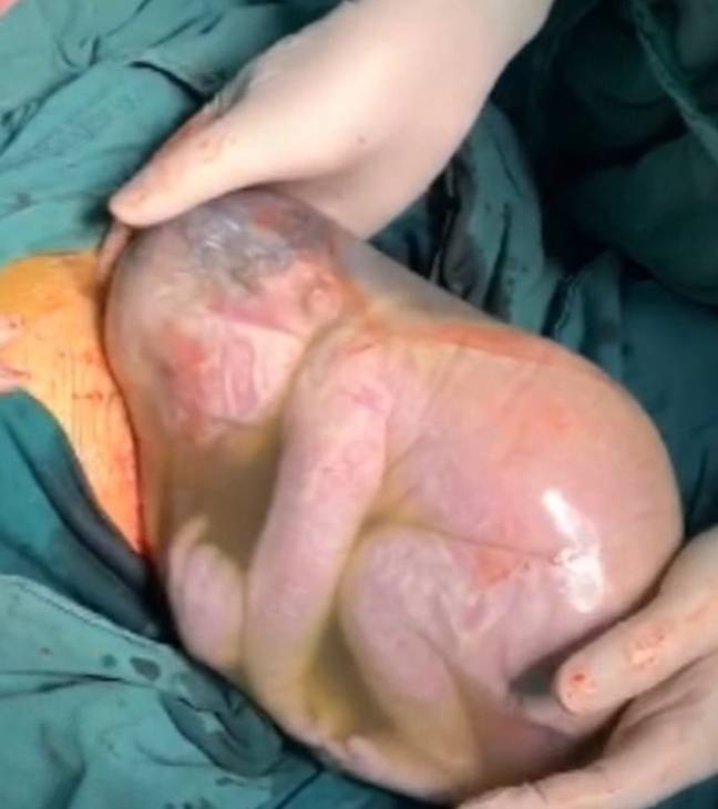 The baby boy seemed perfectly content inside the amniotic sac. Credit: AsiaWire 