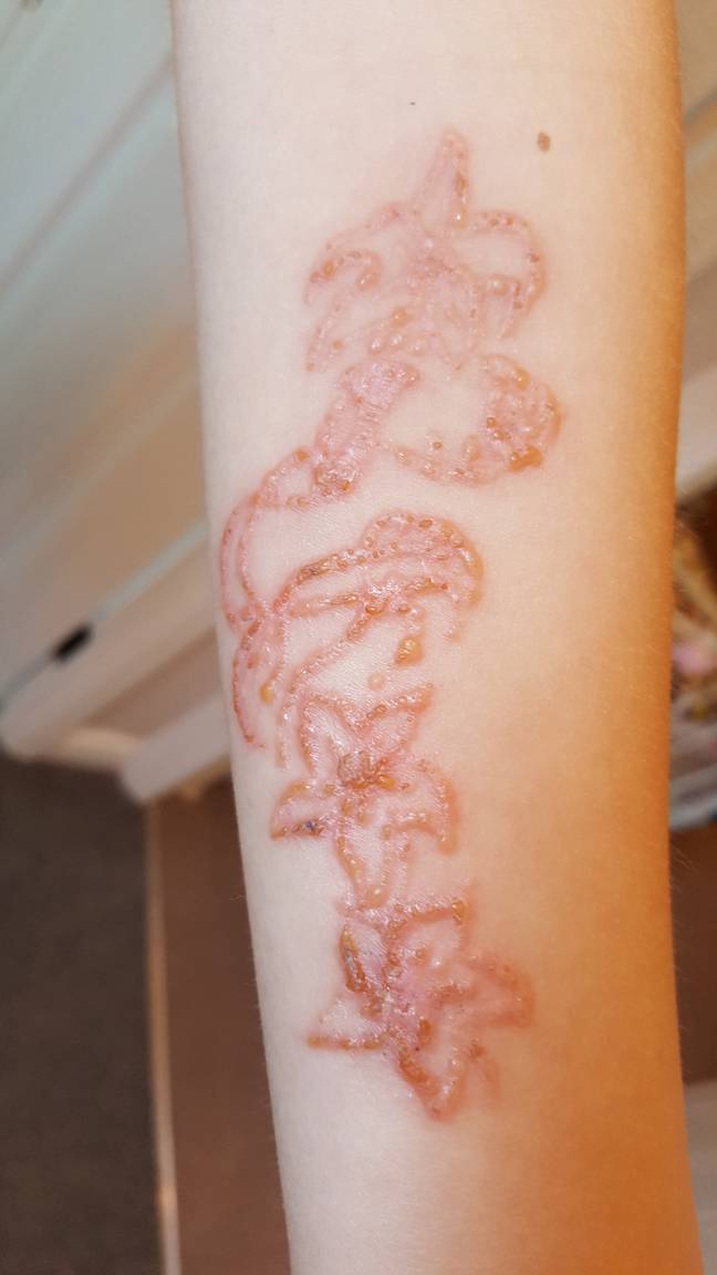 Henna tattoo gone wrong