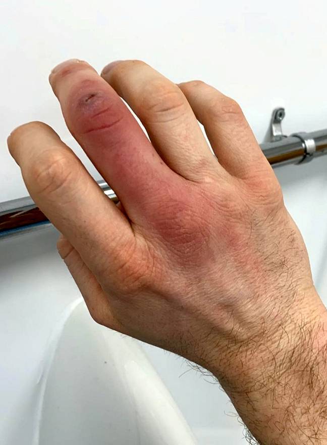 Steve's finger and hand went red and swollen. Credit: SWNS