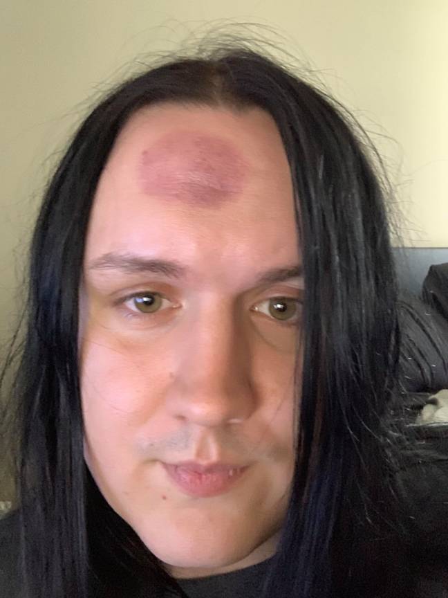 Michiah ended up with a massive bruise on his forehead. Credit: Kennedy News and Media