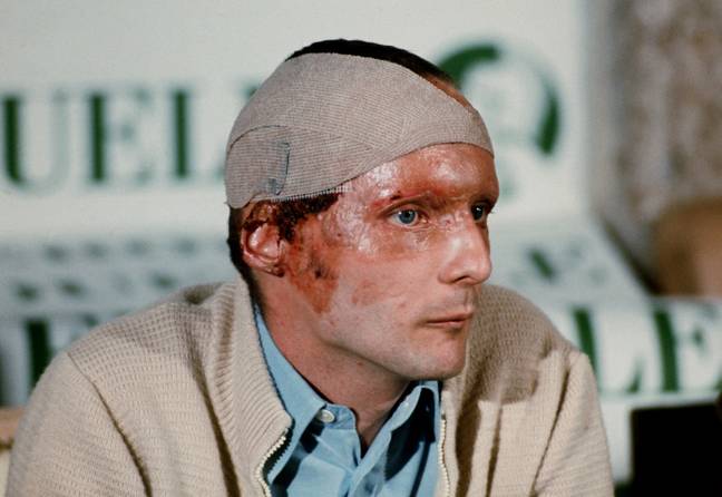 Lauda's severe facial burns following the incident. Credit: PA