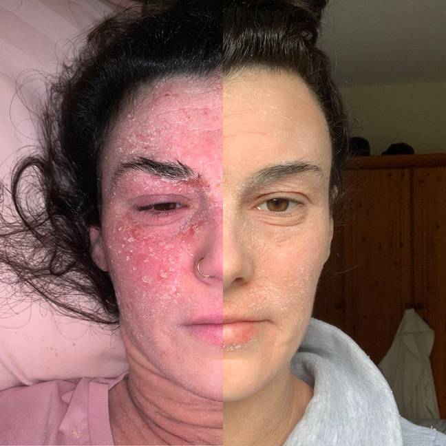 Stephanie is seeing some real results with her skin (Credit: MDW Features)