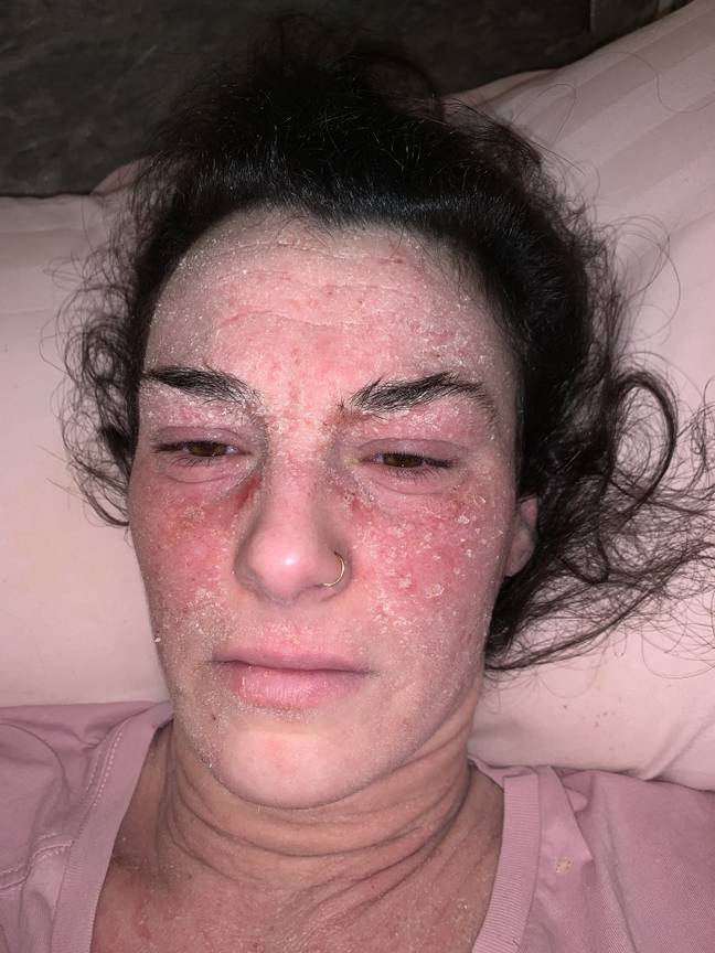 When Stephanie was made redundant in 2018, her eczema flared up worse than ever (Credit: MDW Features)