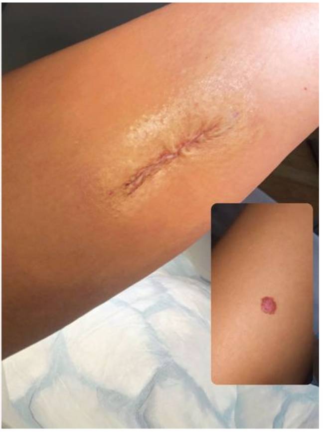Molly-Mae shared a picture of her scar (Credit: Molly-Mae)