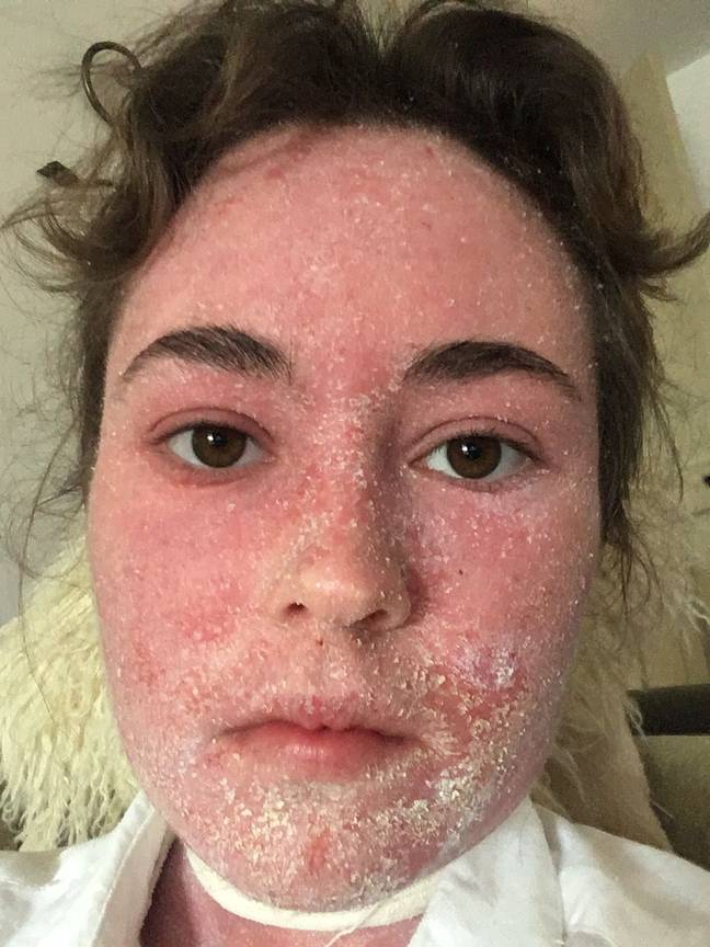 Holly's eczema has troubled her for years (Credit: Media Drum World)
