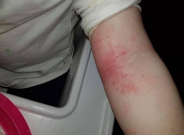 Grace's eczema before the treatment (Credit: Kasey Axall)