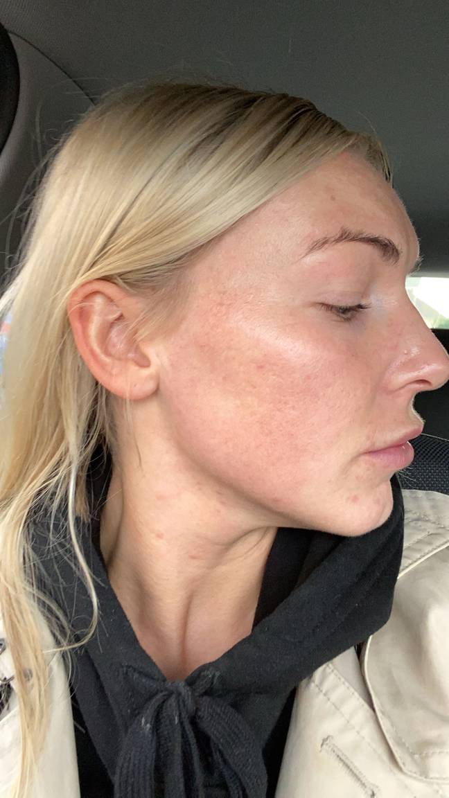Using Roaccutane has changed Ella's life (Credit: Caters)