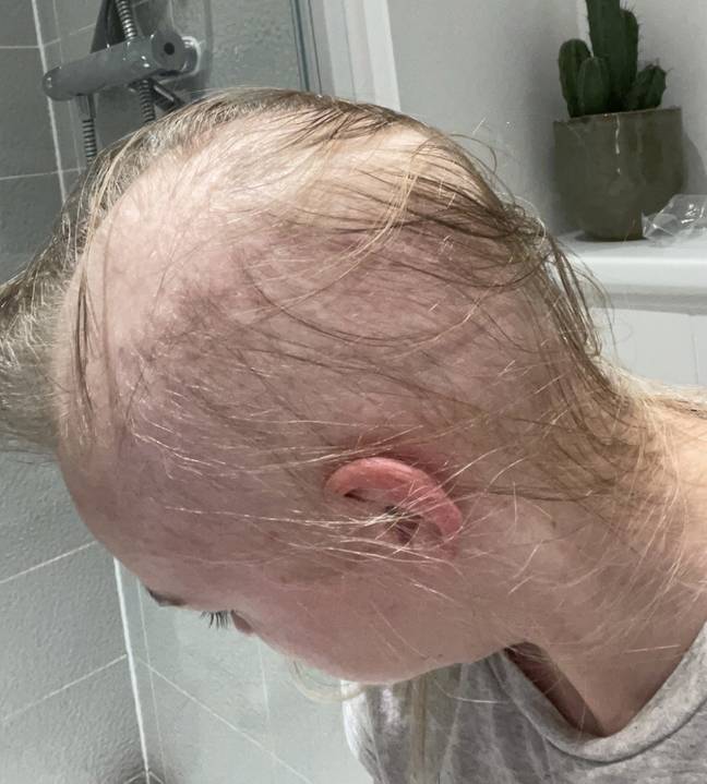 Sophie only had wispy strands before shaving her head (Credit: SWNS)