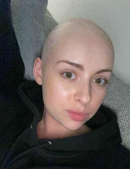 Sophie shaved her head when her hairloss reached 90% (Credit: SWNS)