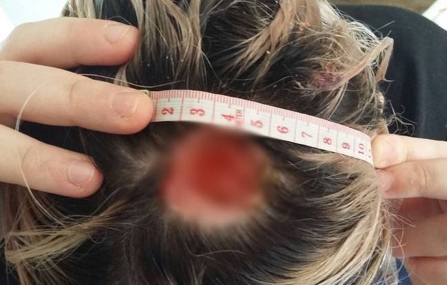 Days later, a clump of Izi's scalp fell off as her mum bathed her head (Credit: PA Media)
