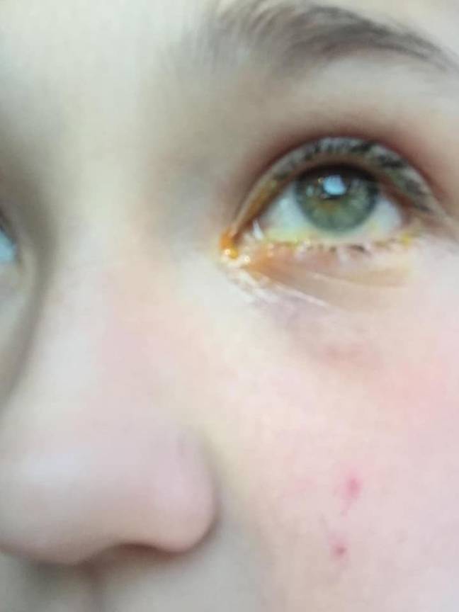 Eye doctors confirmed she'd suffered a burn to her eye (Credit: Kennedy)