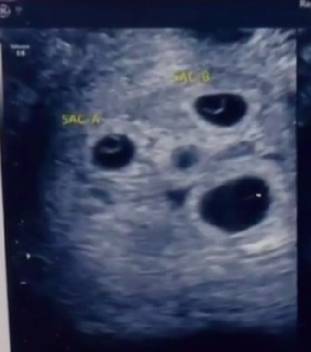 Four babies could be seen in the scan (Credit: KETV)