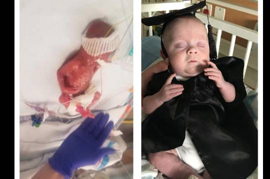 Baby Potter at 22 weeks and when he left the hospital. Credit: Molli and Robert Potter