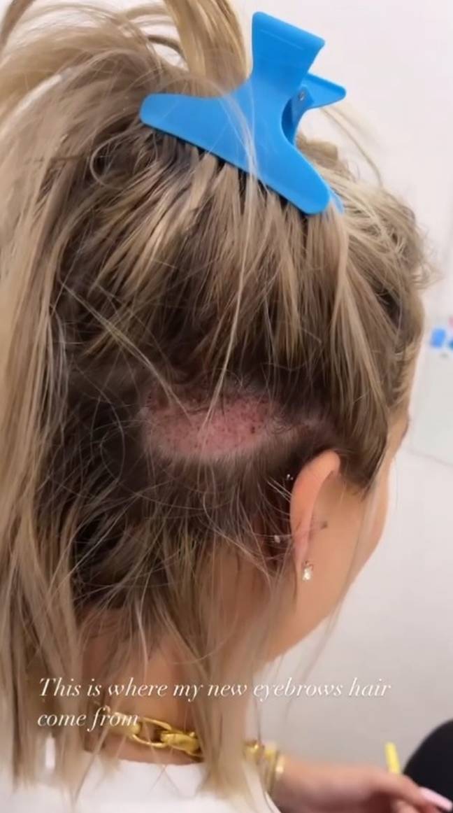 Hair follicles were taken from the back of Isabelle's head. Credit: Kennedy News &amp; Media