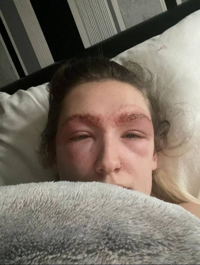 Megan was rushed to hospital when she could no longer see due to the swelling. Credit: SWNS