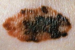 Look out for a mole that has changed colour or has more than two colours to it (Credit: NHS)