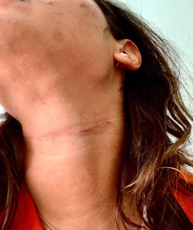 Malin Andersson shared a picture of her neck scars in a brave bid to start a conversation on domestic violence. Credit: @missmalinsara/Instagram