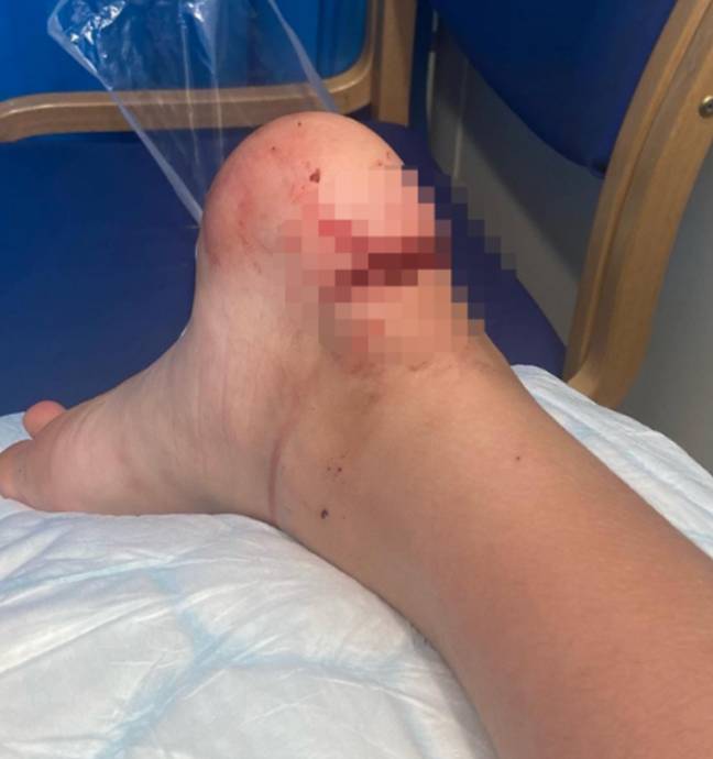 Lucy Gotellier's son Alex had been on a school trip to Camber Sands when he tripped and fell onto a disposable barbecue. Credit: SWNS