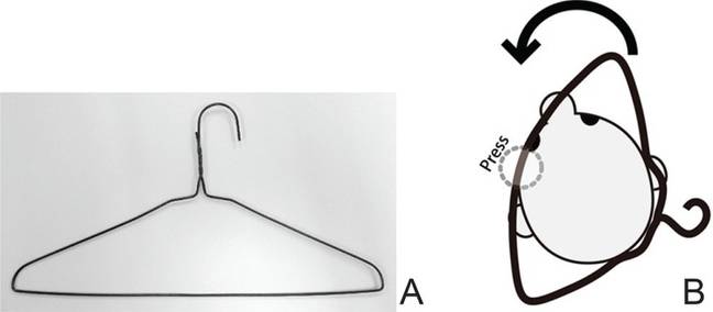 A diagram on how the hanger should be placed from the 2015 study. Credit: Neurol Med Chir (Tokyo)