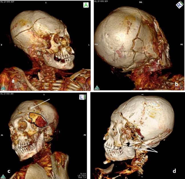 A 3D scan of the Delemont mummy also shows head trauma. Credit:  A-M Begerock, R Loynes, OK Peschel, J Verano, R Bianucci, I Martinez Armijo, M González, AG Nerlich