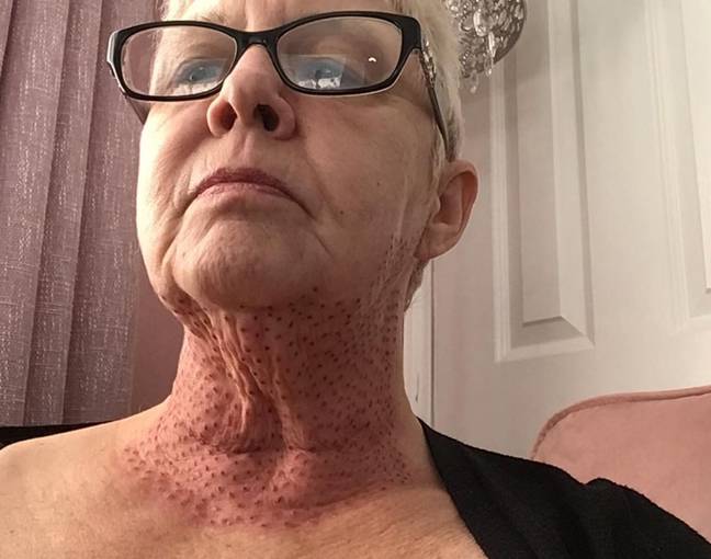 Hampshire-based Jayne Bowman, 59, paid £500 to have a fibroblast therapy treatment but was left with red blotches. Credit: Wales News Service