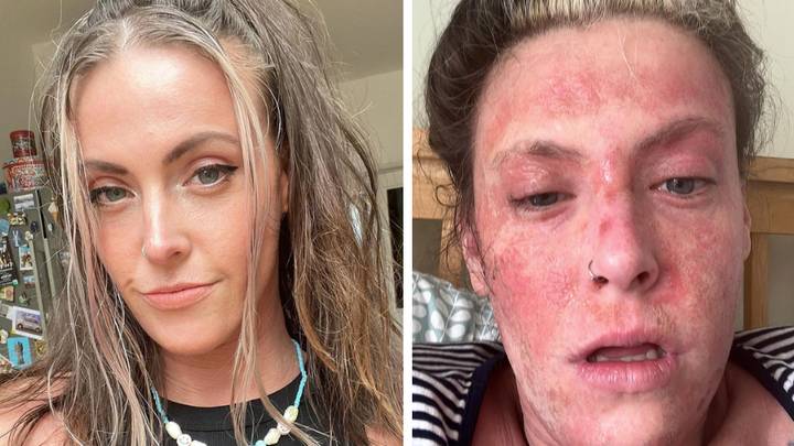Woman 'couldn't leave the house' after experiencing horrific withdrawal symptoms from eczema creams