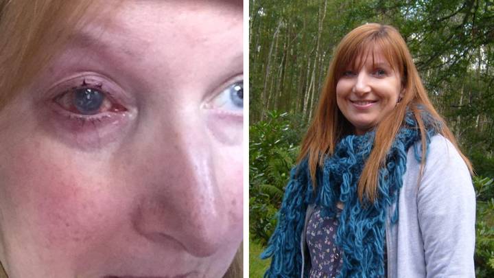 Woman had to have eye removed after wearing contact lenses in the shower