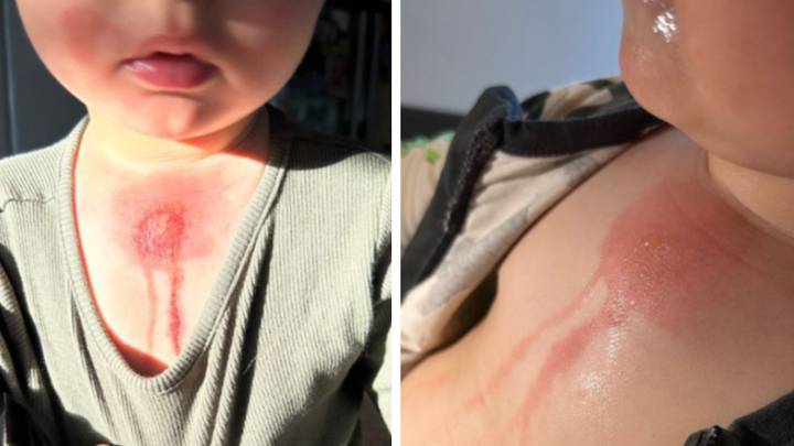 Mum horrified after child suffers 'margarita burn' to chest