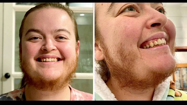 Woman Says She's 'Free' After Ditching Razor To Let Beard Grow