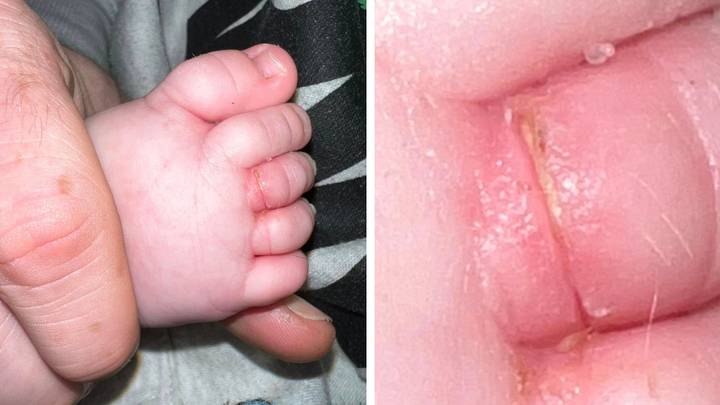 Mum urges parents to check their baby's toes after hair 'cut off blood supply'