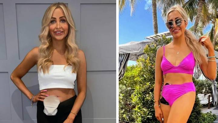 Woman whose colon and rectum have been removed feels more confident with stoma bag