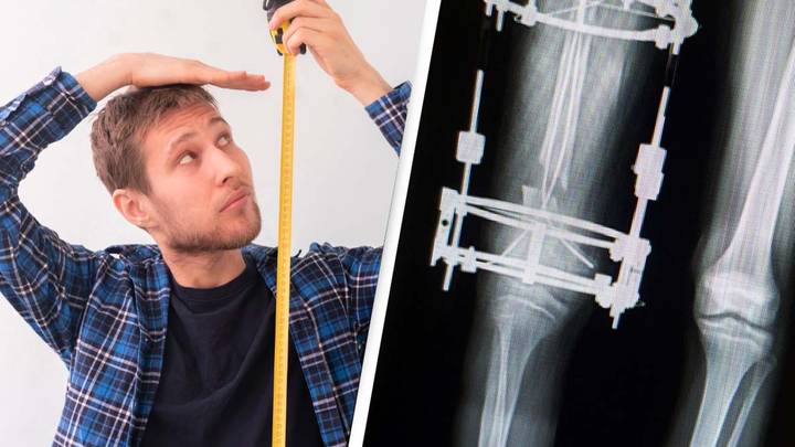 Man spends $75,000 to become 3 inches taller