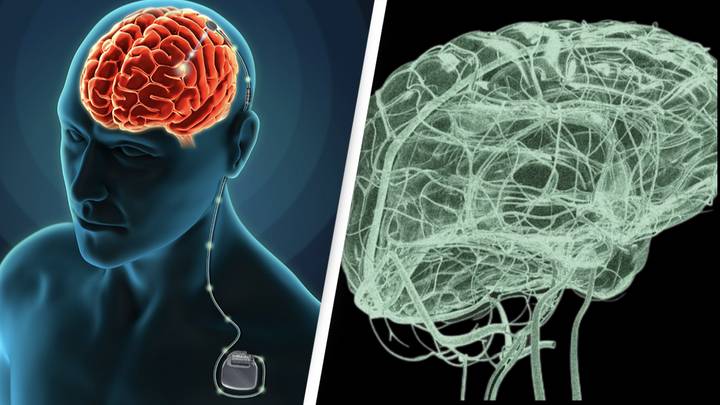 Elon Musk's Neuralink Rival To Give Six Paralysed People Brain Implants In US