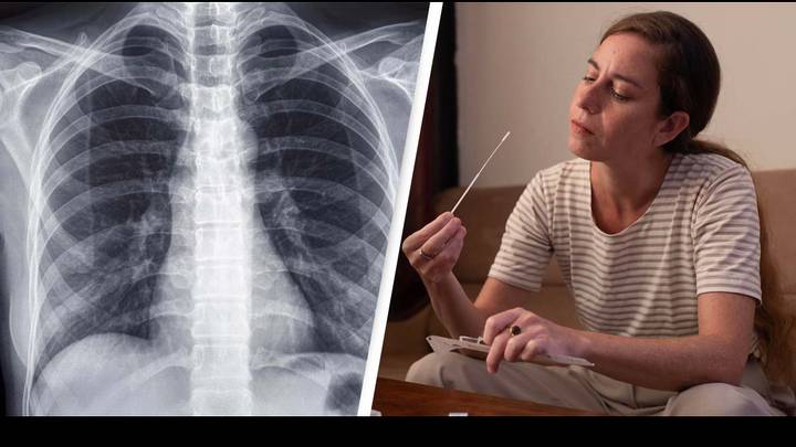 Long Covid: Hidden Lung Damage Detected On Scans