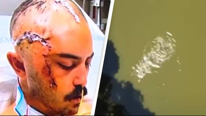 Man loses quarter of his skull after alligator attacks him