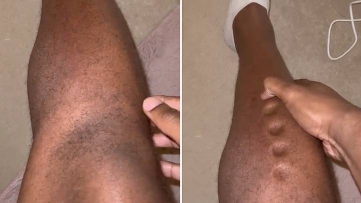 Olympian shocks fans with alarming video after legs 'turn to Play-Doh'