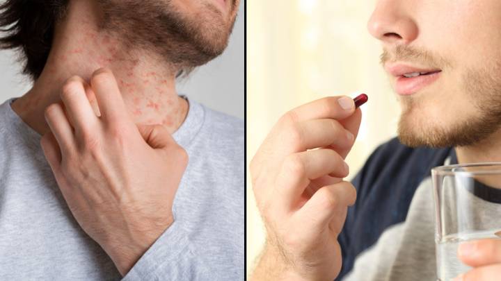 NHS Given Green Light For Eczema Pill That Can Clear Skin In A Week