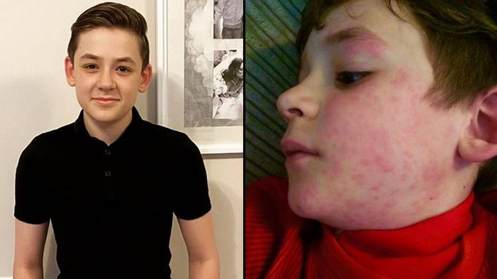 Teenager's Allergy To Cold Means Walk To School Could Kill Him