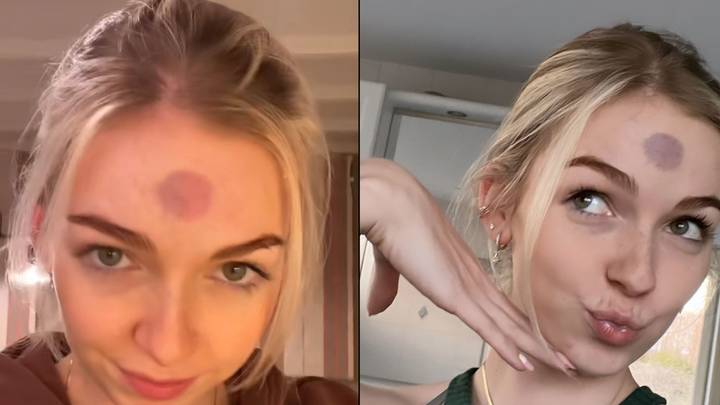 Woman Forced To Go To Work With Huge Bruise On Forehead After Sex Toy Disaster