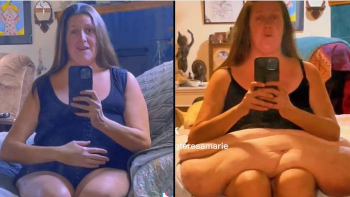 Woman who lost more than 160kg undergoes surgery to get rid of excess skin