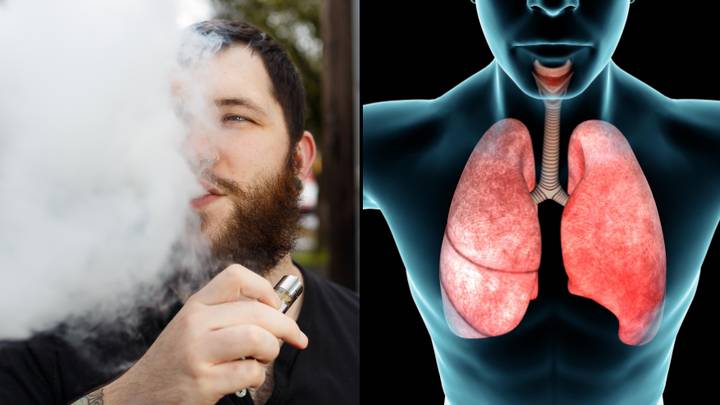 Expert Warns Vape Users Of Serious Risk Of Popcorn Lung That Can Be Fatal