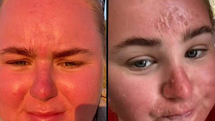 Woman Shares Horrific Sunburn After Just One Hour In UK Sun