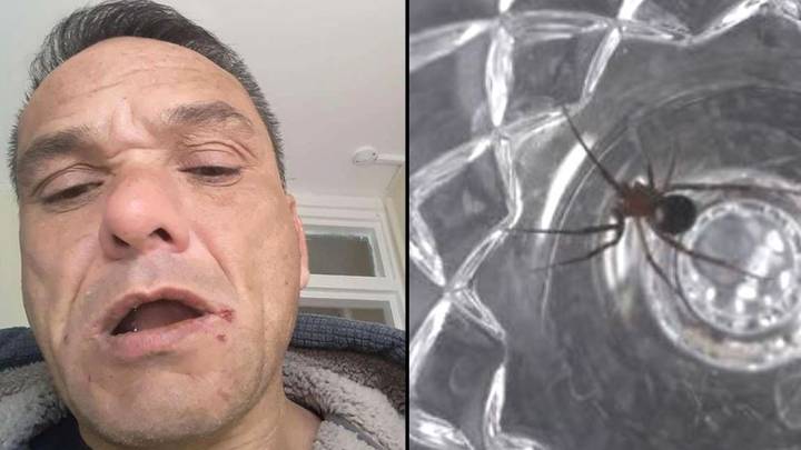 Man Says He's Been Bitten More Than 100 Times By False Widow Spiders Living In Flat
