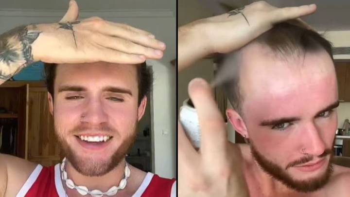 Man Shares After Results After Having Month-Long Sex Ban To Protect Hair Transplant